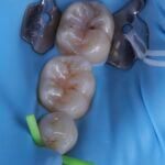 La diga di gomma è l'unico metodo sicuro ed efficace per ottenere ricostruzioni durature