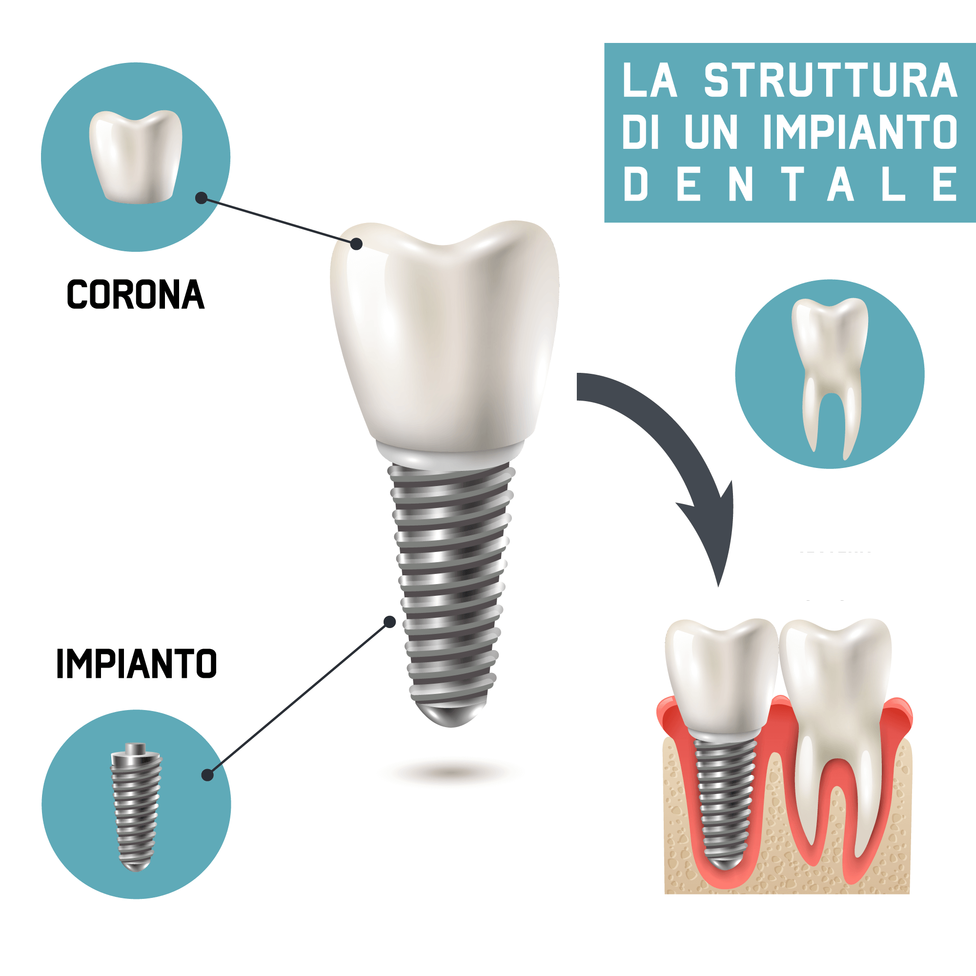 Struttura degli impianti dentali