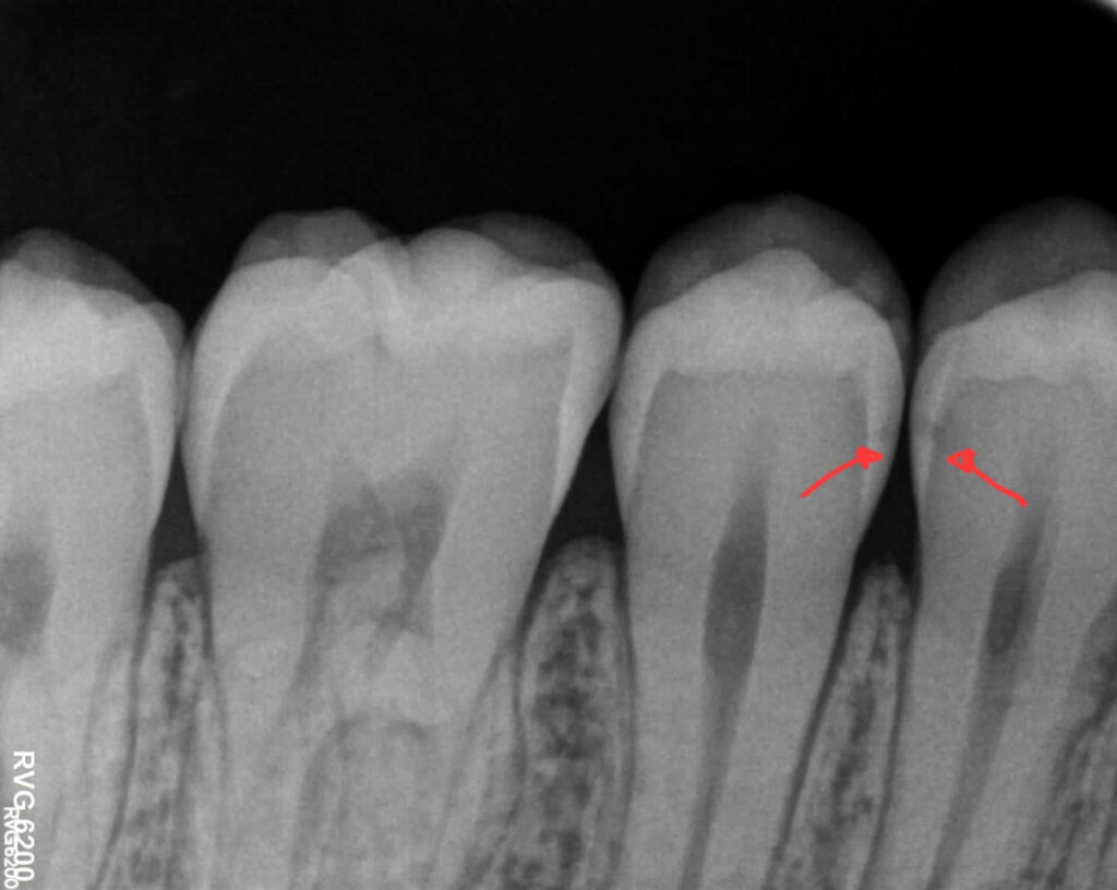 L'importanza della visita dentistica effettuata regolarmente: lesioni cariose allo stadio iniziale